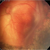 Retinopathy of prematurity stage 4A