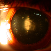 Posterior Cortical Cataract