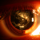 Mittendorf Cataract (associated with persistent fetal vascularization)
