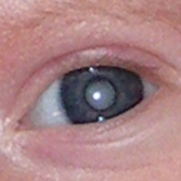 Total Cataract (Leukocoria)