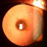 Corticosteroid-induced Cataract