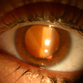 Coats Disease. Exsudative retinal detachment