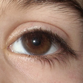 Microcornea (right eye)