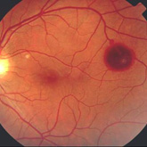 Valsalva retinopathy. Courtesy dos Drs JC Filipe e V Leal