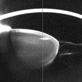 Crystalline lens luxation (Pentacam). Courtesy Dr L Torrão