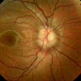 Optic nerve drusen
