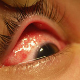Subconjunctival Emphysema - Ocular Trauma