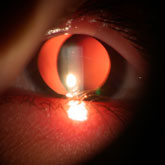 Crystalline lens luxation - Marfan syndrome