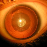 Cataract - associated with aniridia