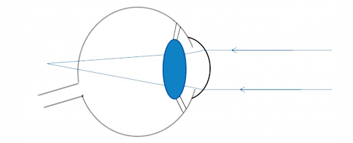 Hipermetropia: os feixes luminosos focam atás da retina